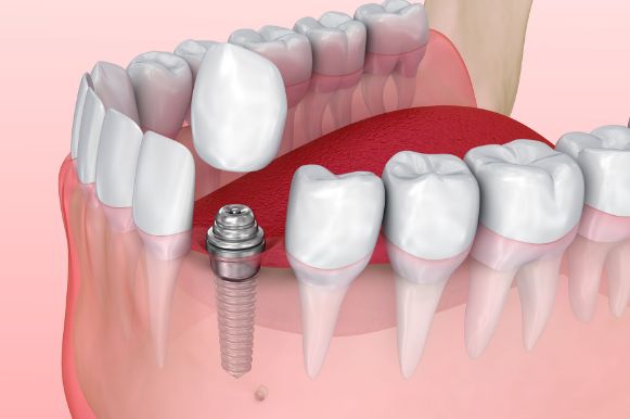 インプラント症例